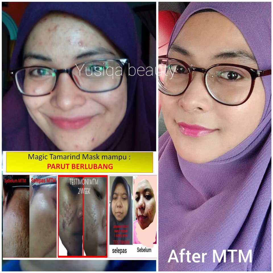 Pimple Jerawat Breakout Parut Oily Dan Kusam Magic Tamarind Mask Original Hq Shopee Malaysia