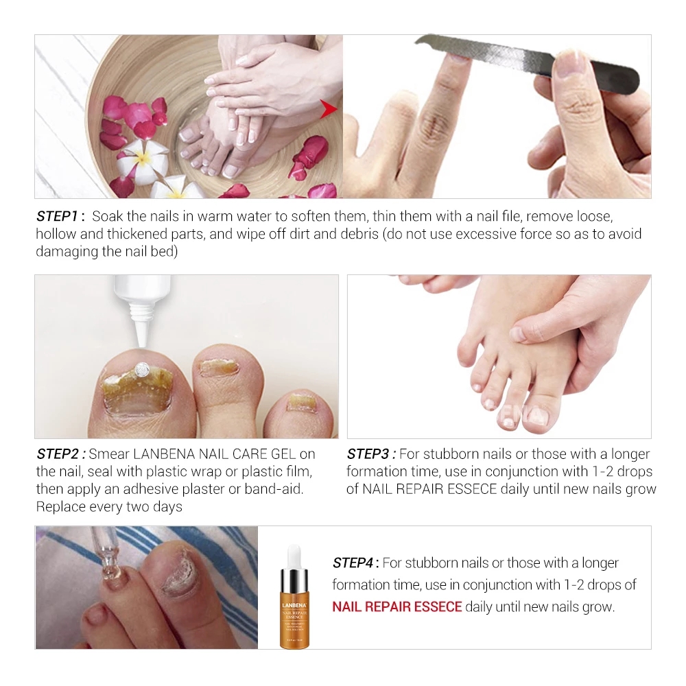 LANBENA Nail Care Gel Fungal Nail Treatment Remove Onychomycosis Nail Care  | Shopee Malaysia