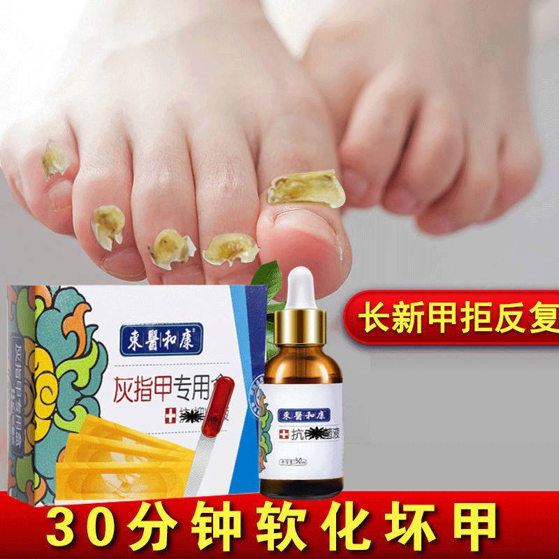 灰指甲药 灰指甲特效药增厚快速治疗甲沟炎抑菌液软甲亮甲专用药灰甲净药水 Shopee Malaysia