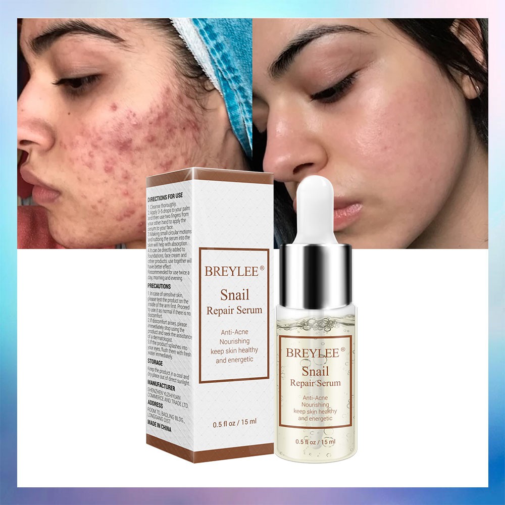 essence for acne prone skin