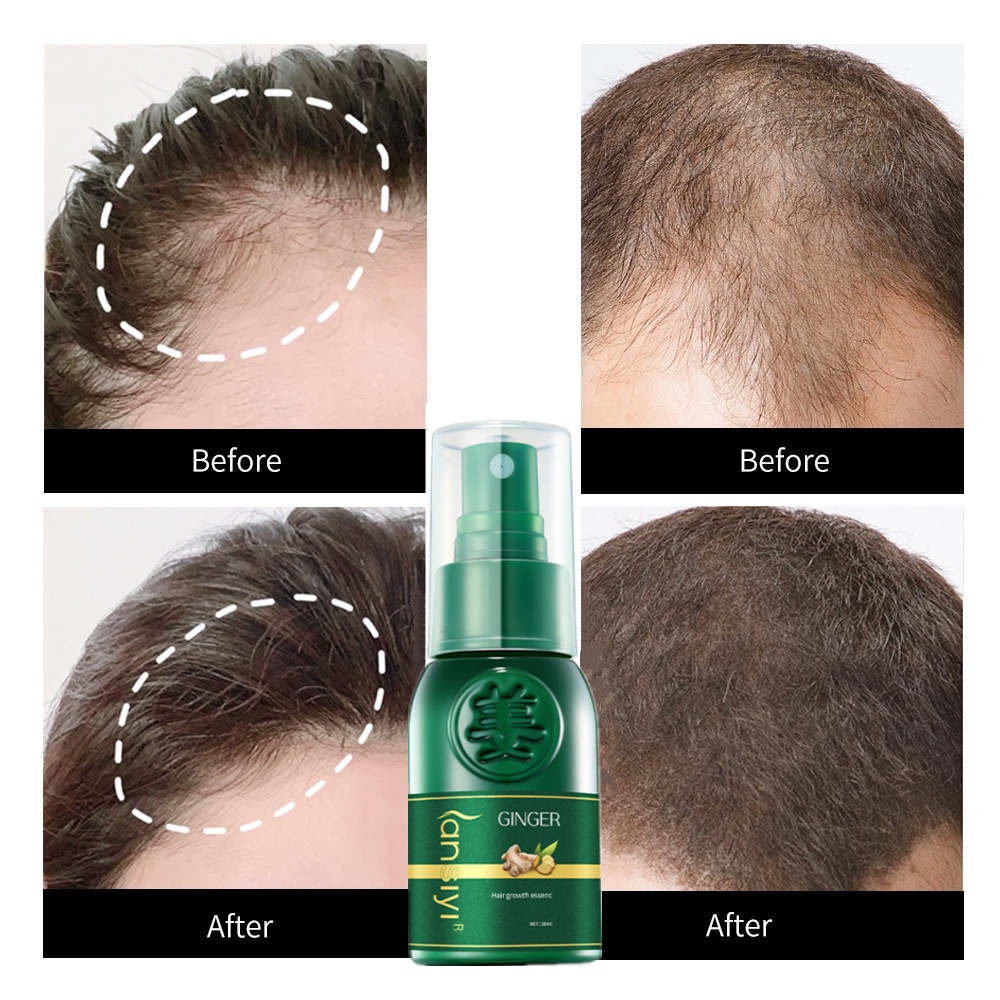 hair growth serum hair tonic growth Anti hair loss Improve hair follicles  Nourishing Hair root Thinning Hair Spray 生发液 | Shopee Malaysia