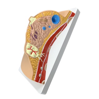 Median Section of Human Female Breast Cancer Anatomical Model ...