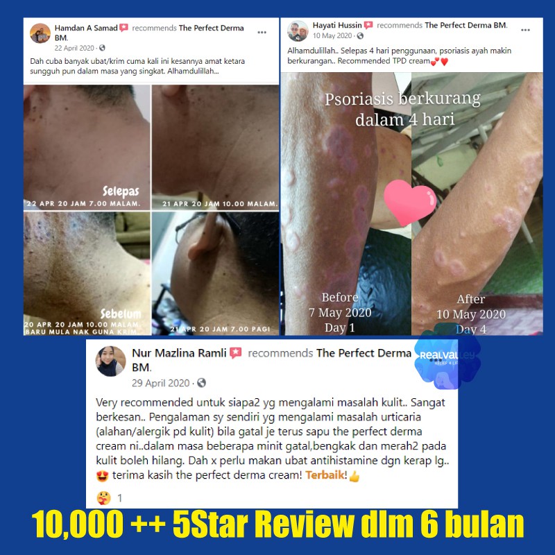 The Perfect Derma Cream Tpd Ekzema Krim Hilangkan Kurap Kaki Badan Kepala Anak Ekzema Cream Muka Ruam Kulit Gatal Shopee Malaysia