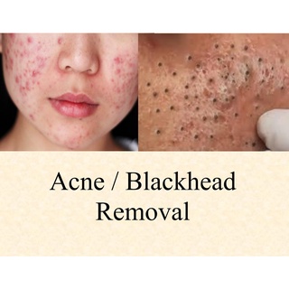 ACNE / BLACKHEAD REMOVAL WITH DEEP CLEANSING EXFOLIATING MASK HI FREEQUENCY
