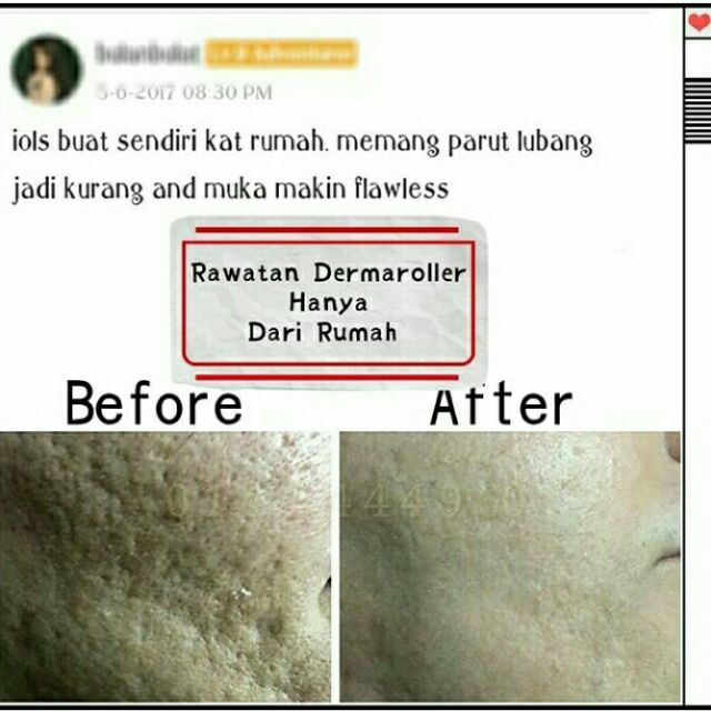Dermaroller Parut Berlubang Serum Jerawat Dermapem Microneedle Acne Scar Shopee Malaysia