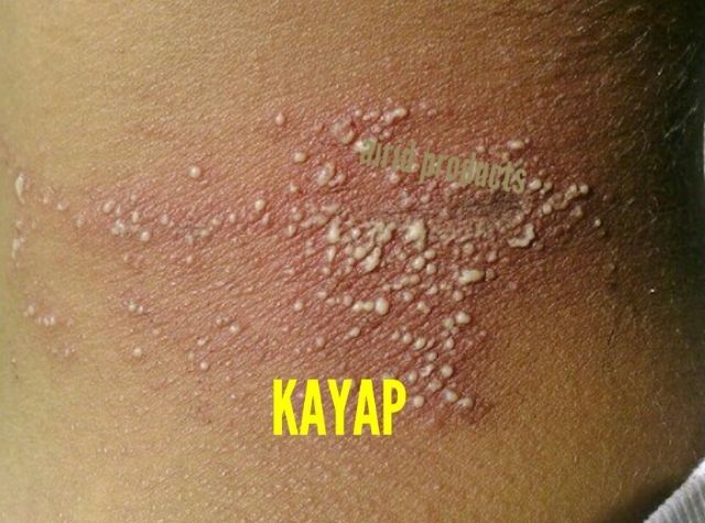 Pagoda Salep Ubat Kurap Kayap 10g Jerawat Ubat Kurap Ubat Kudis Panau Kayap Shopee Malaysia