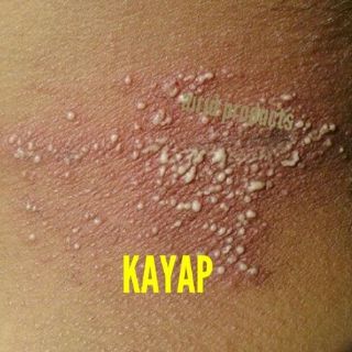 Pagoda Salep Ubat kurap kayap 10g jerawat ubat kurap ubat 