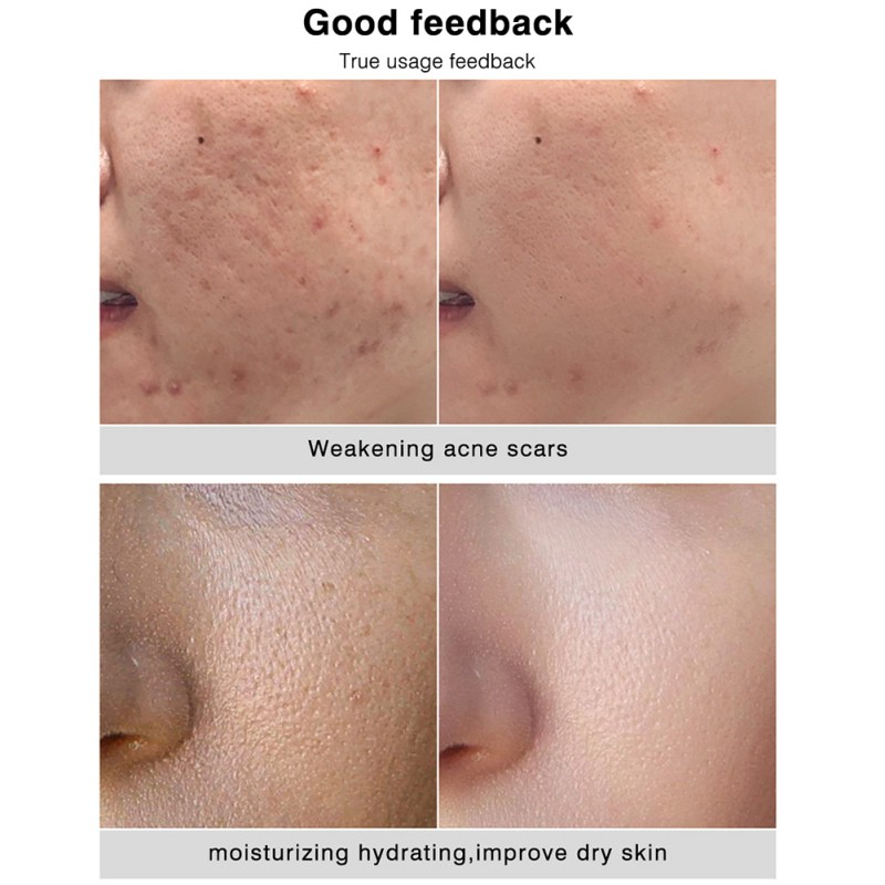 dry acne scars