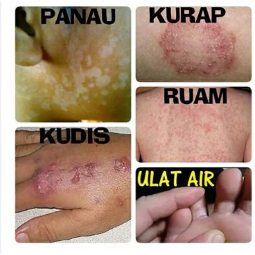 Krim Kurap Psoriasis Kudis Gatal Kulit Gatal Kayap Sensitif Panau Kutu Air Luka Kecil Sangat Berkesan Shopee Malaysia