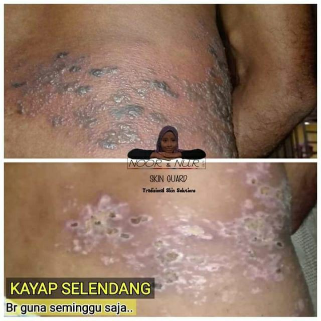 SKIN GUARD PENAWAR KAYAP KURAP KULAT AIR ECZEMA  Shopee Malaysia