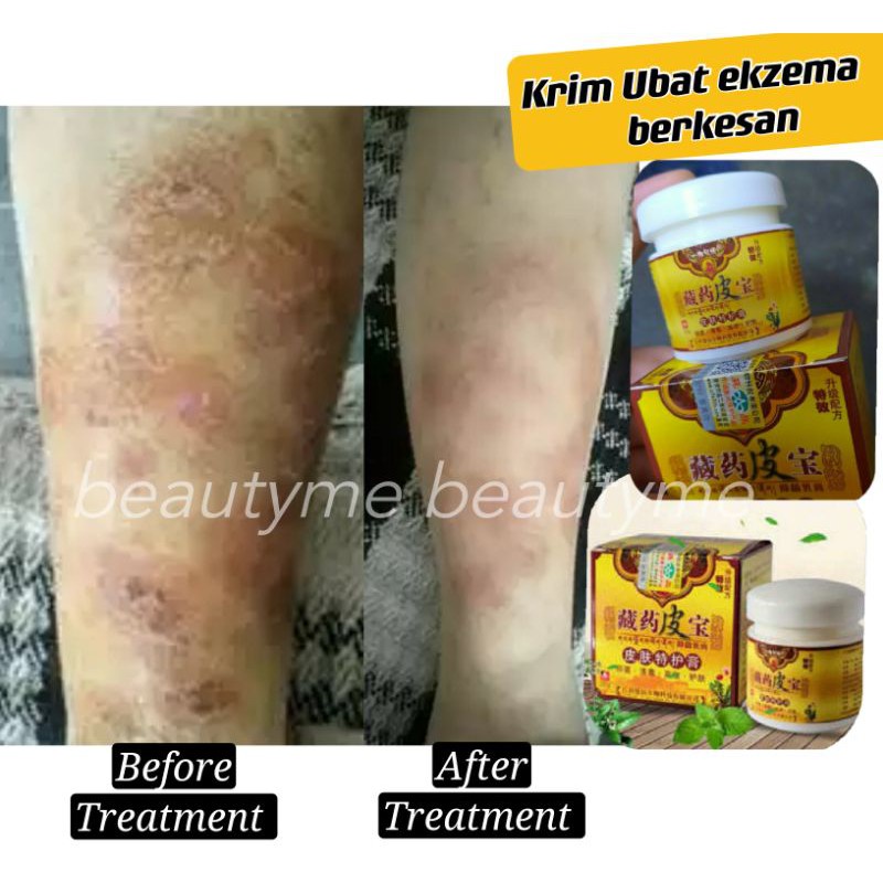 Jumbo Size20g Halal Ubat Ekzema Berkesan Psoriasis Gatal Kurap Kudis Scabbies Ruam Eczema Anti Itching Medical Cream祛痒膏 Shopee Malaysia