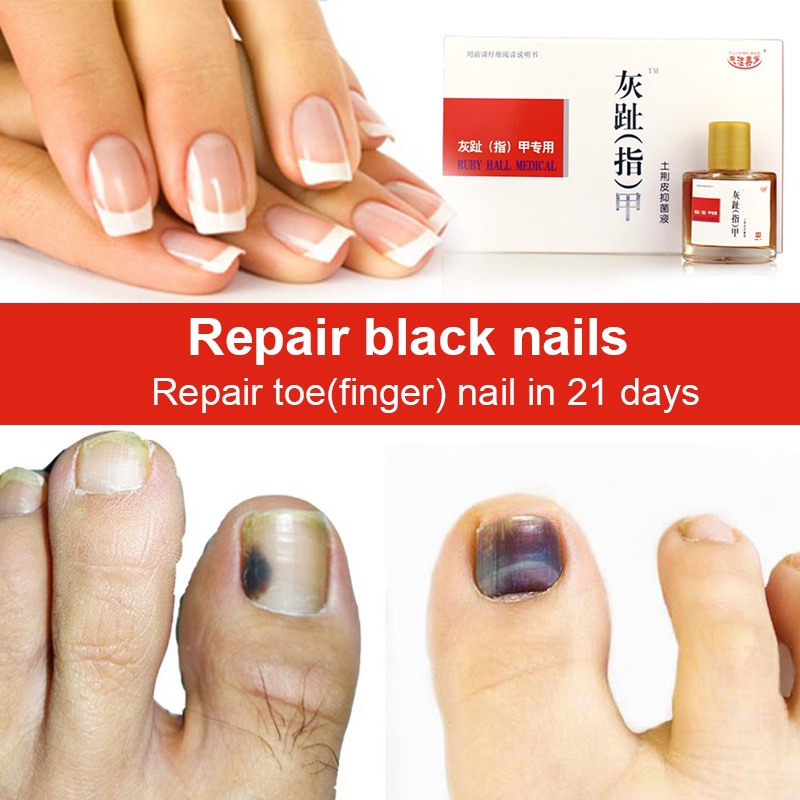 AntiFungal Nail Treatment Onychomycosis Paronychia Repairs