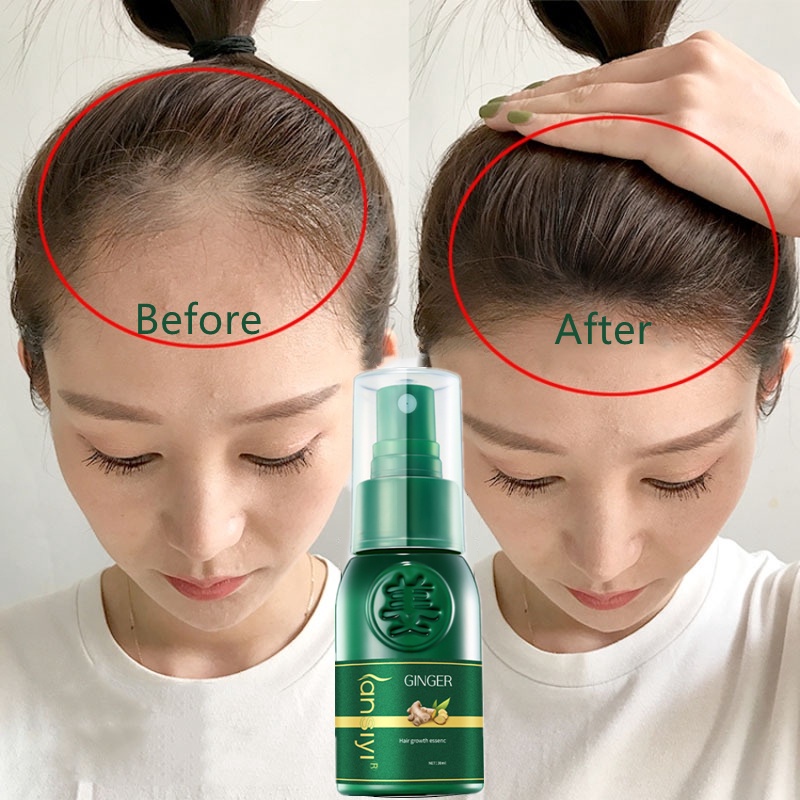 Anti hair Loss Liquid Hair growth spray Nourishing Hair Root Thinning Hair  Improve hair follicles Dense Hair Hair Care | Shopee Malaysia