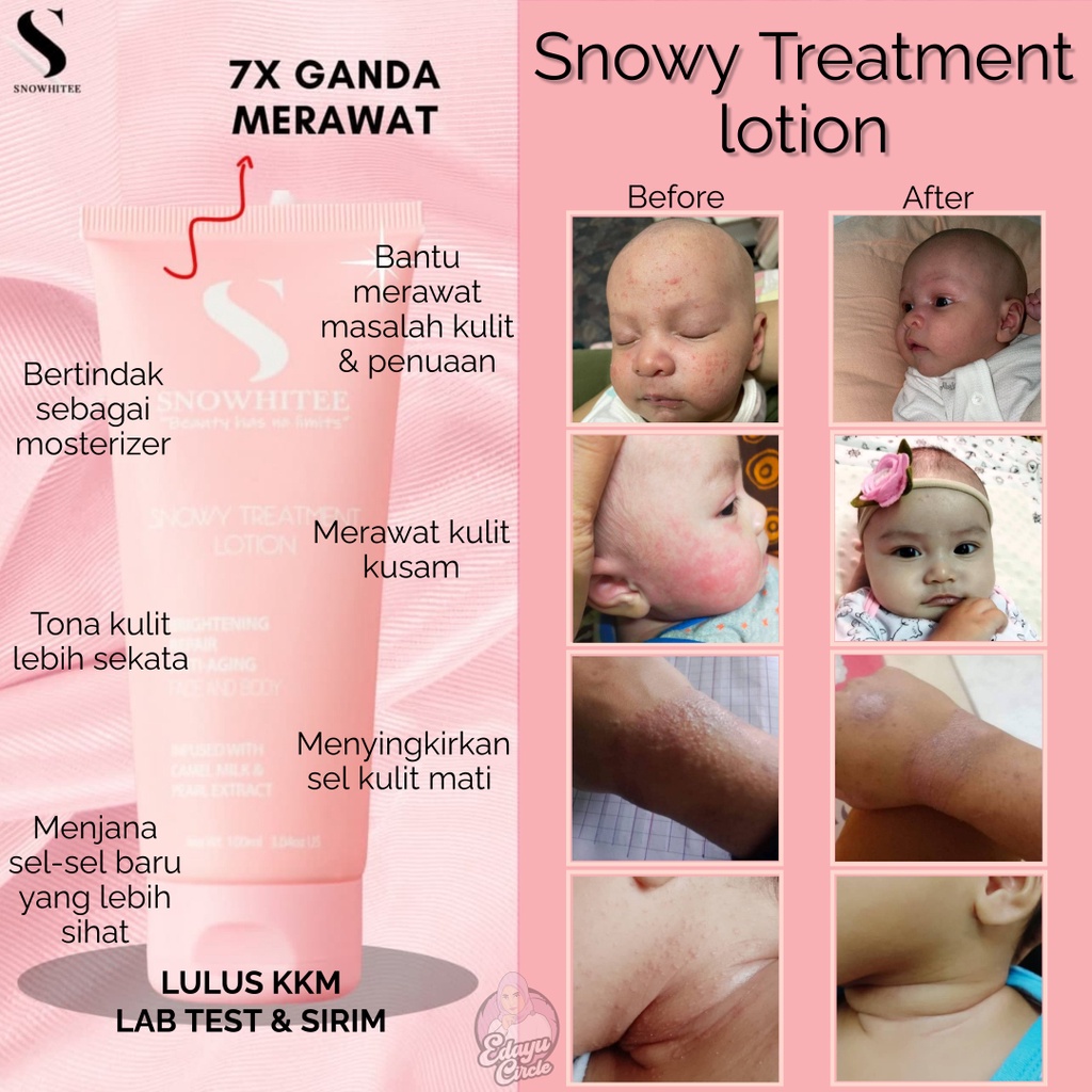 Lotion Treatment Snowhitee Membantu Merawat Masalah Kulit Eczema Psoriasis Alergik Lotion Susu Unta