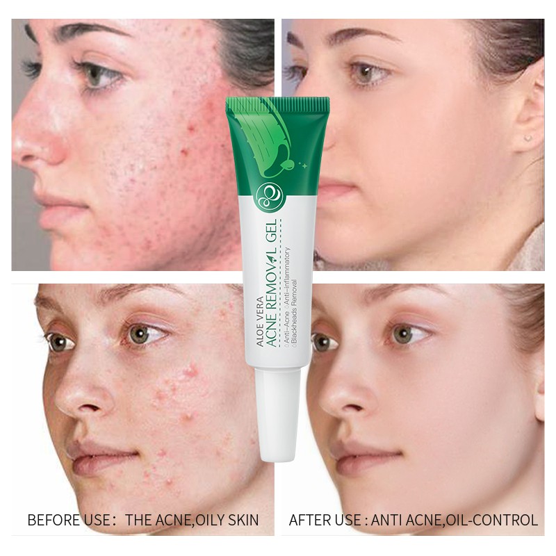 aloe vera acne products