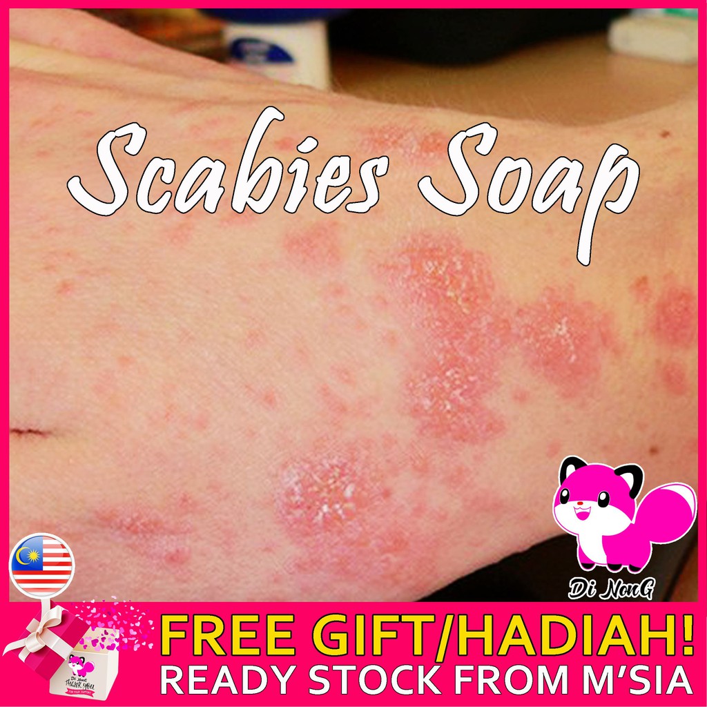 Ubat Gatal Antifungal Antibacterial Scabies Herbal Soap Psoriasis