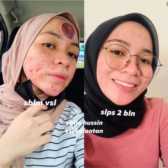 skincare vsl