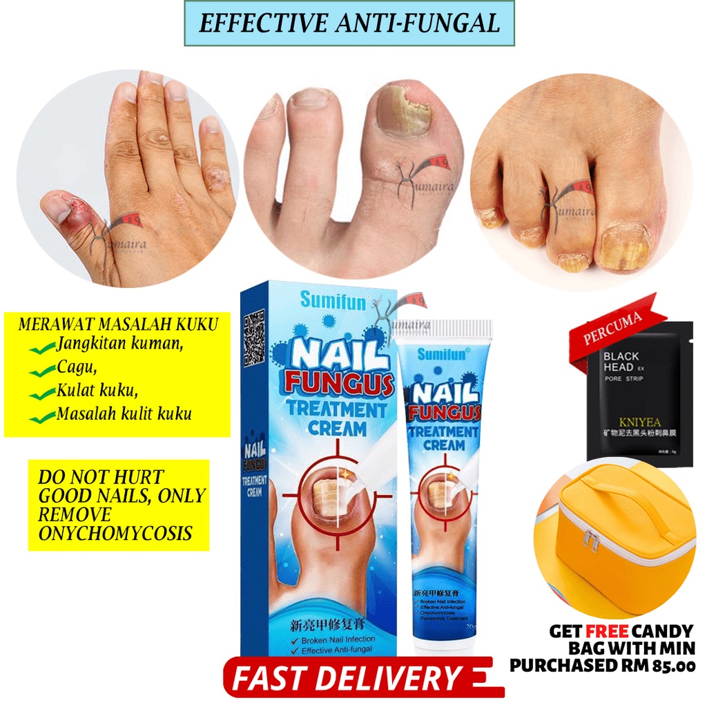 Jangkitan Kulat Kuku Kaki Tangan Cagu Kuku Merekah Sumifon Nail