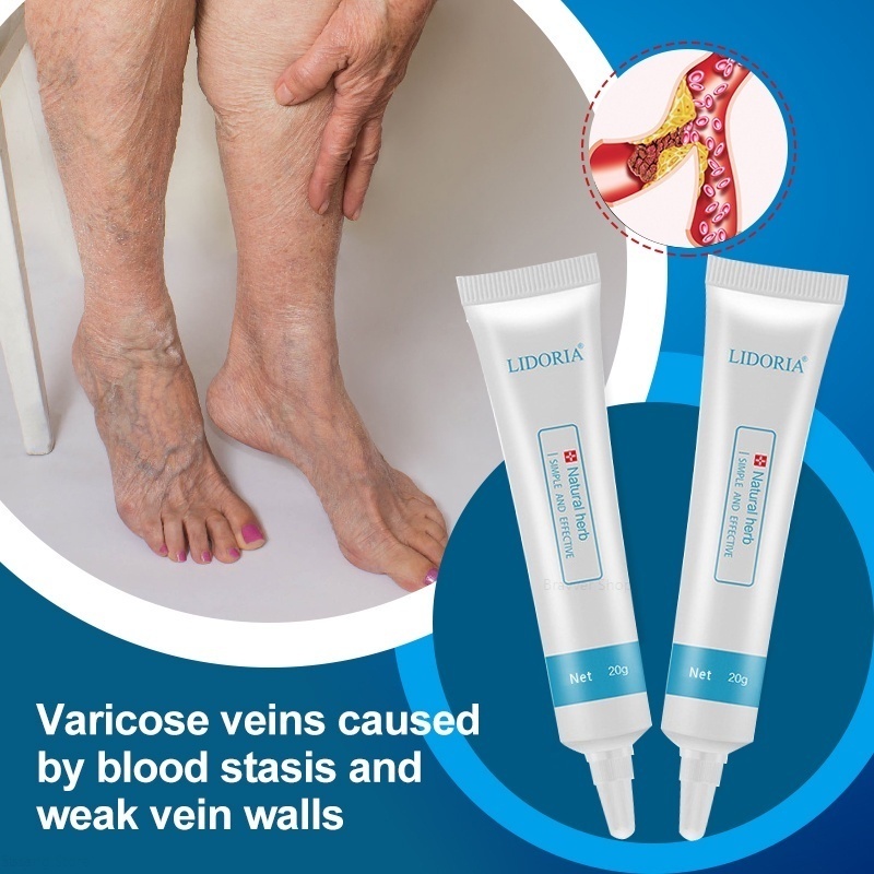 Varicose Repair Cream 20g Natural Chinese Herbal Varicose Veins ...