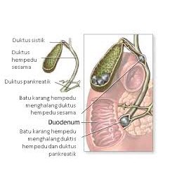 10S CRUSH TREATMENT (BATU KARANG) - 100% WITHOUT DRUGS, WOOD ROOTS 