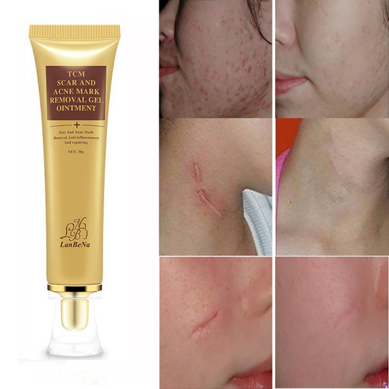 acne scar removal products