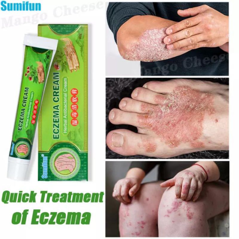 Ubat gatal kulit ekzema berkesan Eczema cream Ubat gatal cina Sumifun