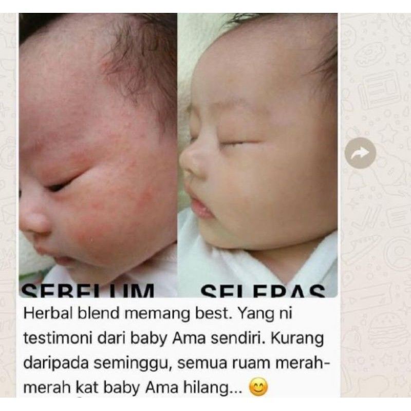 Herbal Blend Krim Untuk Exzema Lembut Pada Kulit Baby Paraben Free Shopee Malaysia