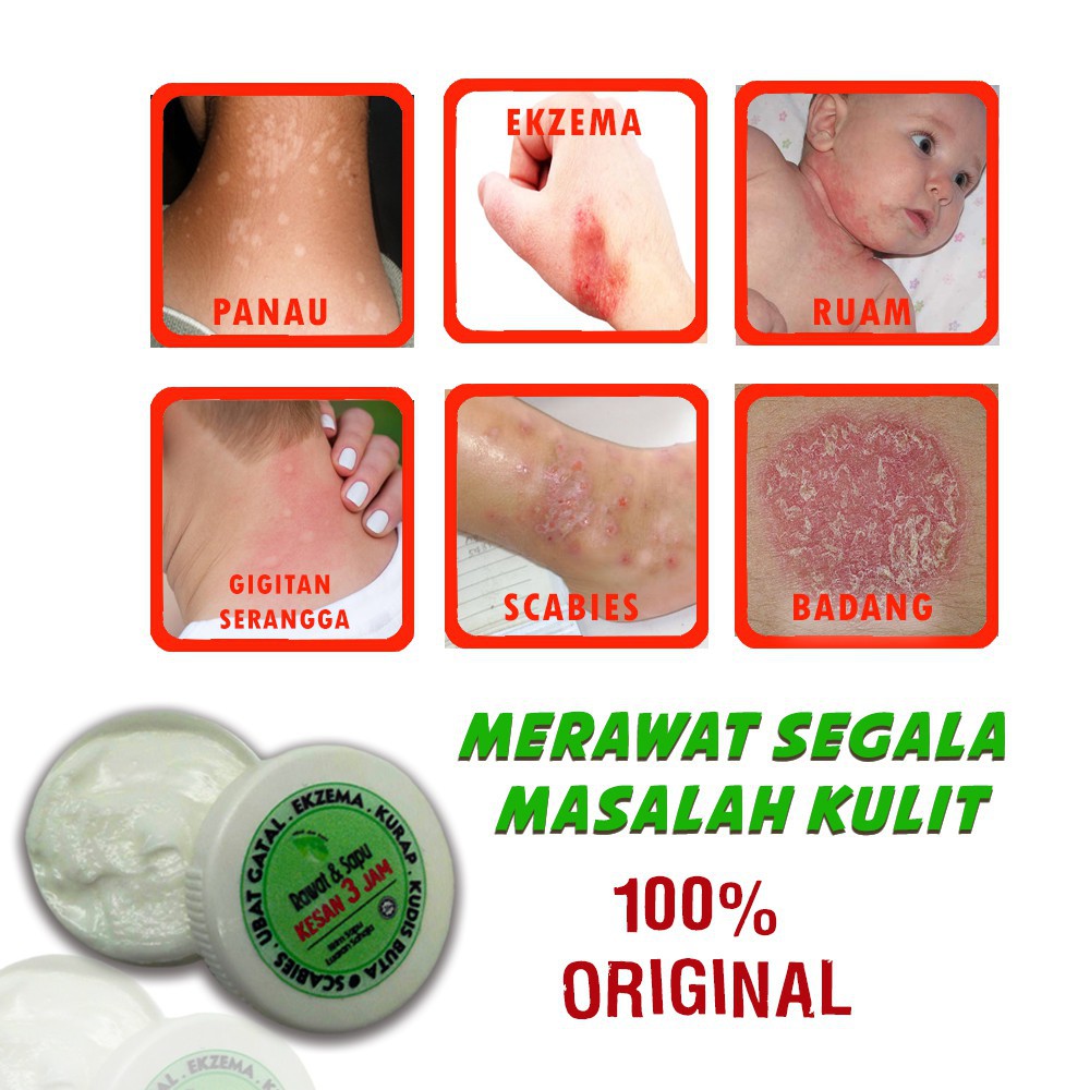 In malay scabies Scabies Treatment