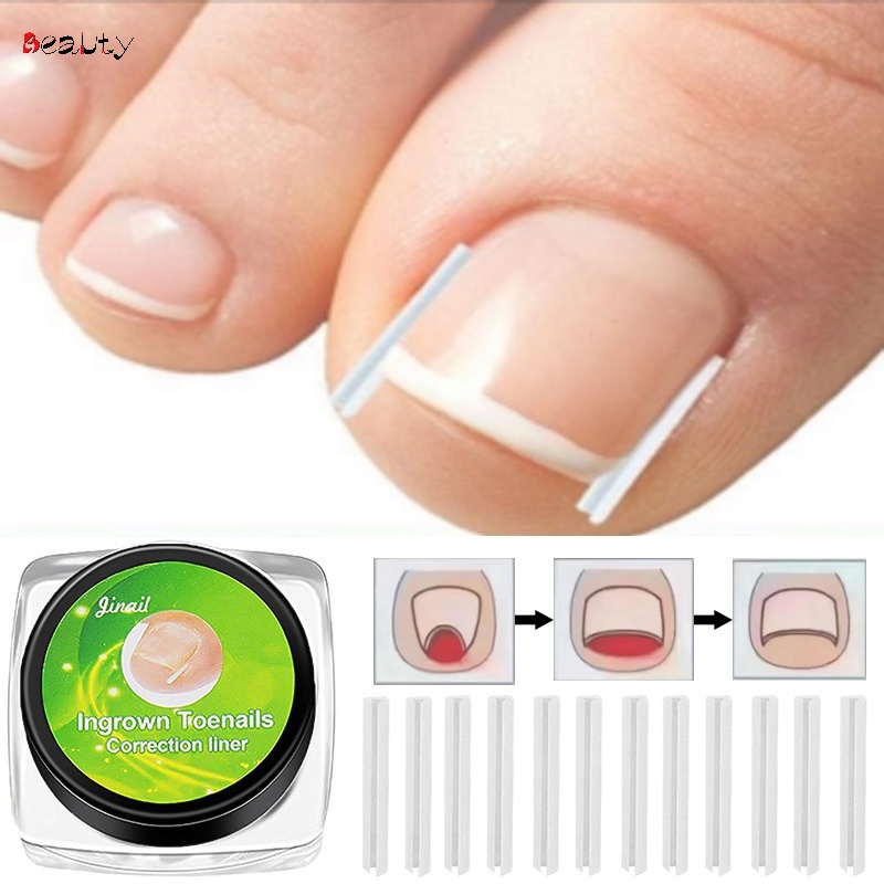 10pcs/bottle Ultra-thin C-shaped Tube Nail Groove Ingrown Nail ...