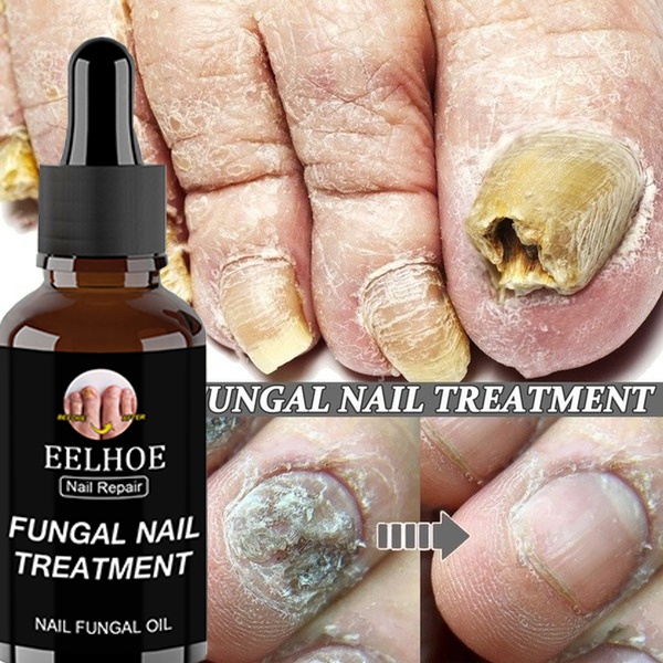 Nail Fungus Treatment Nail Cream Nail Antifungal Nail Care Remove Fungus on  The Fingers and Toenail Fungus Treatment | Shopee Malaysia