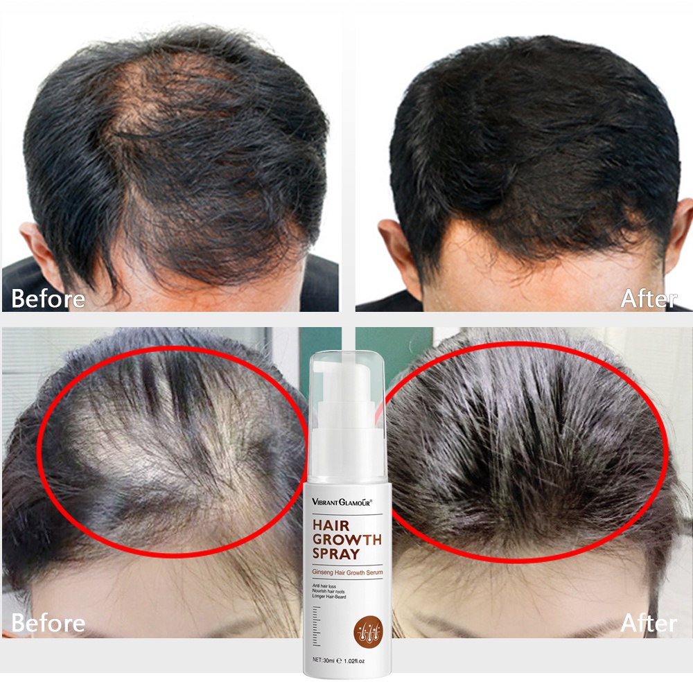 VIBRANT GLAMOUR Natural Hair Growth Essence Spray Prevent Baldness  Consolidate Prevent Hair Loss Nourish Hair Roots