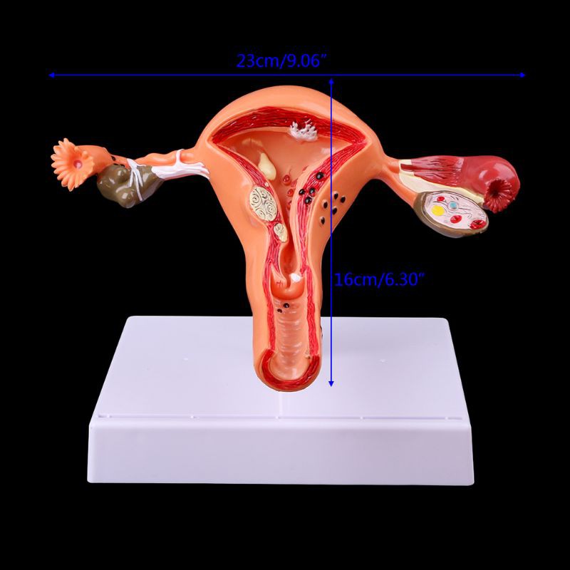 Uterus Ovary Anatomical Model With Pathologies 