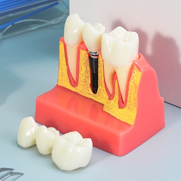 Dental Implant Analysis Crown Bridge Demonstration 4 Times Teeth Model ...