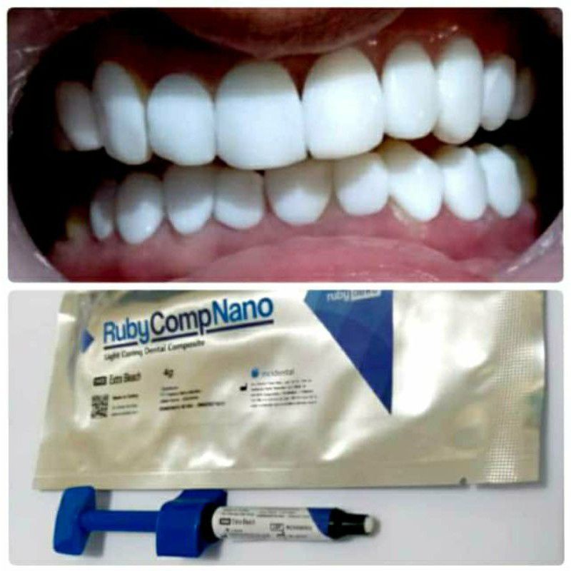 RUBY COMPNANO(RUBY DENT) light curing dental composite 4g Shopee Malaysia