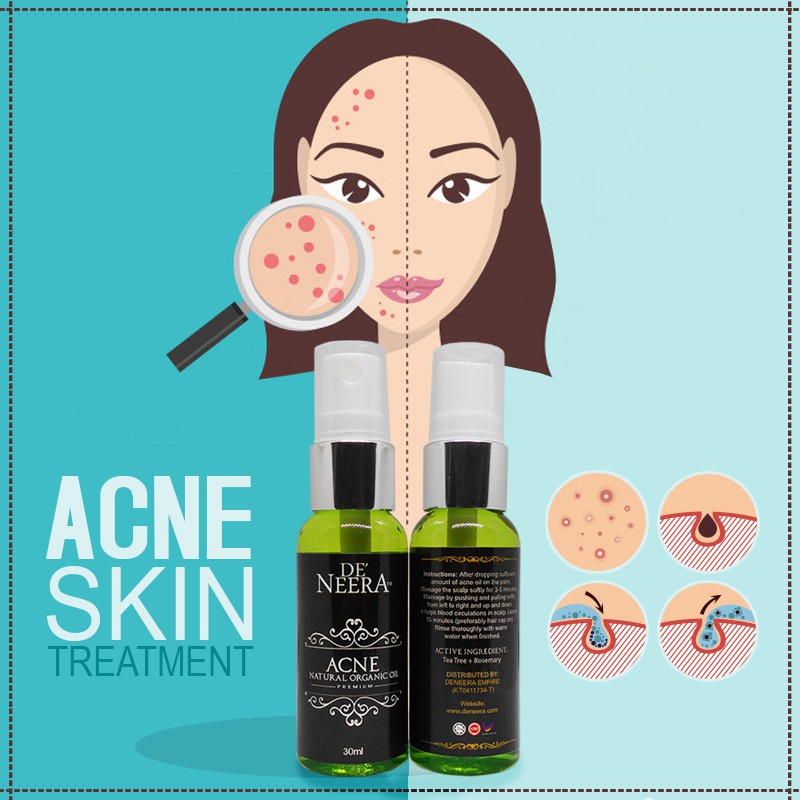 UBAT JERAWAT  MENGHILANGKAN JERAWAT DENGAN BERKESAN  DeNeera