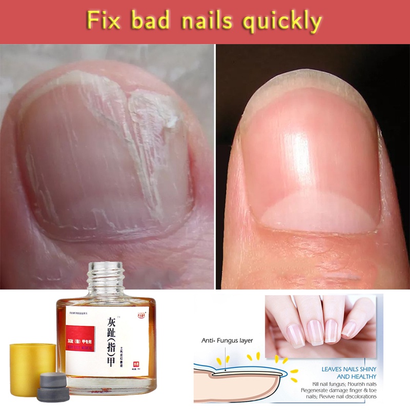 Nail Pen Onychomycosis Paronychia Infection Herbal Quick fix Toe Finger