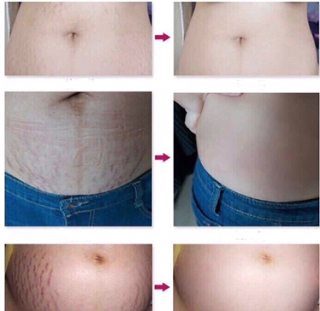 Cream Stretch Mark Aimabird Hilangkan Selulit Parut Lama Dan Baru Parut Luka Terbakar Parut Mengandung Shopee Malaysia