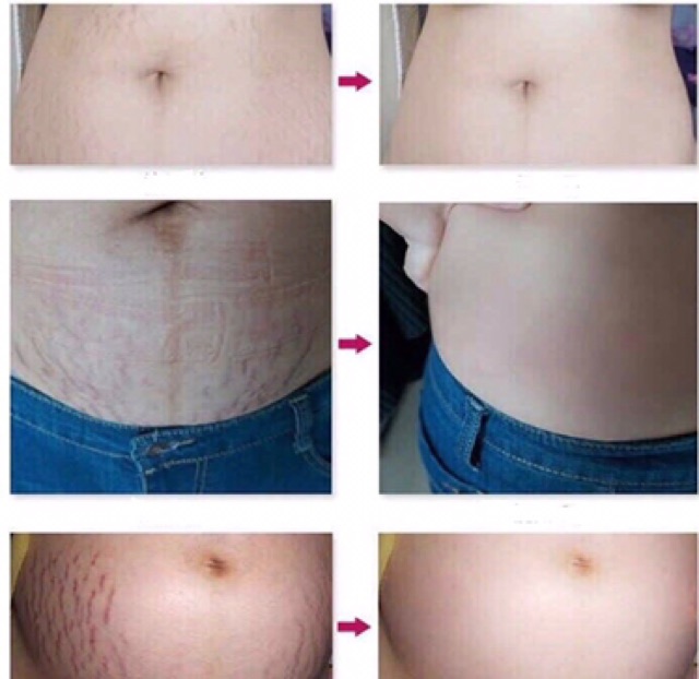 Cream Stretch Mark Aimabird Hilangkan Selulit Parut Lama Dan Baru Parut Luka Terbakar Parut Mengandung Shopee Malaysia