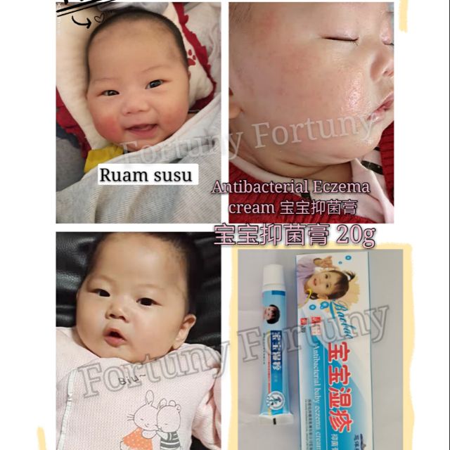 Buy Ready Stock Baby Ekzema Treatment Cream Bayi Krim Ekzema Hilang Gatal Ruam Susu Seetracker Malaysia