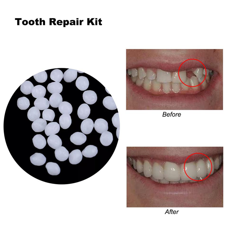 Tooth Enamel Repair Kit Teethwalls