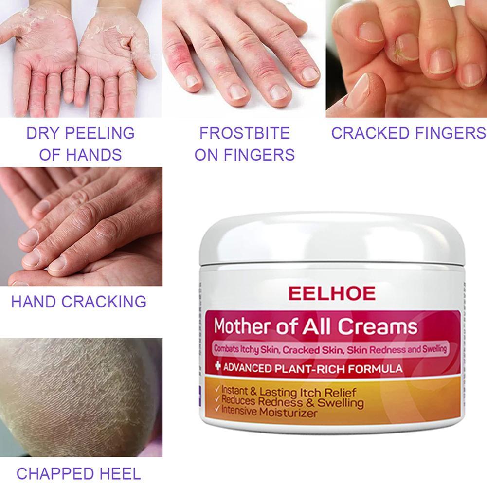 EELHOE Skin Psoriasis Cream Dermatitis Eczematoid Eczema Ointment