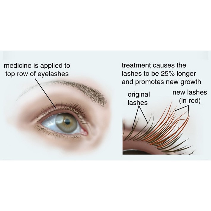 latisse eye discoloration