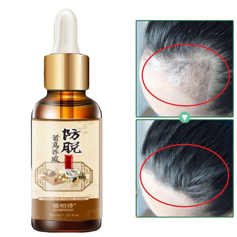Hair Treatment Polygonum Essential Oil Nourishing Scalp Anti-Hair Loss  Promote Hair Growth Effective | Shopee Malaysia