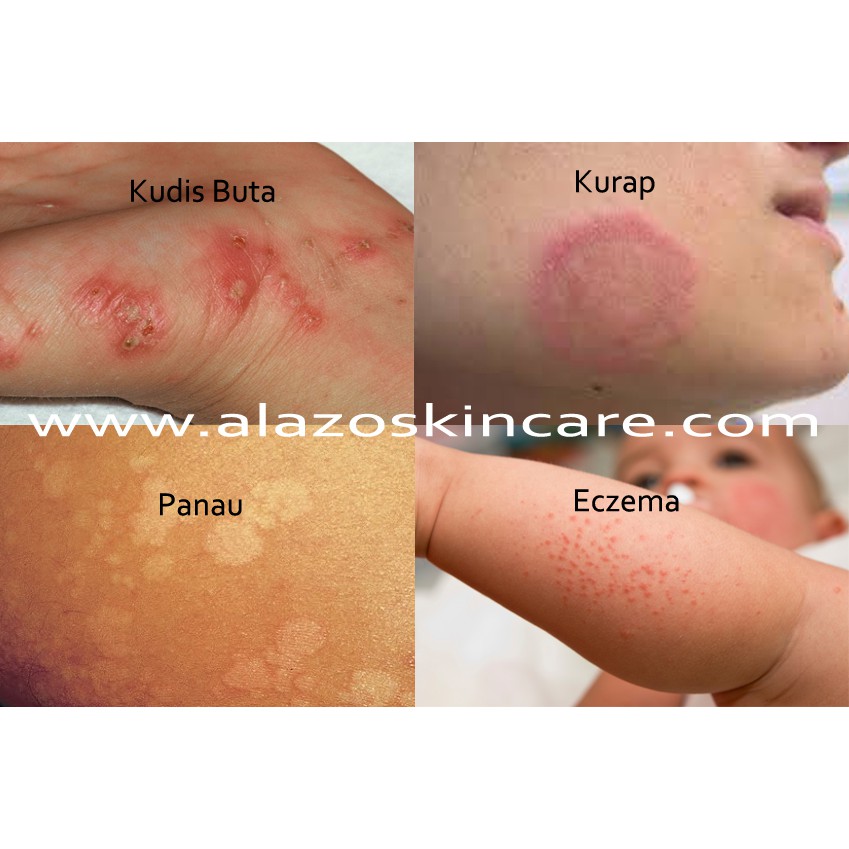 Ubat Gatal Pati Gelenggamg Untuk Panau Badang Kurap Ekzima Kudis Ruam Bintat Gatal Cagu Shopee Malaysia