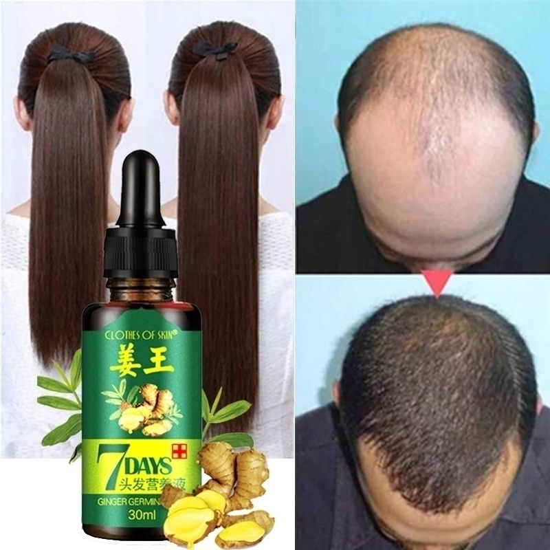 Hair nutrient solution growth solution ginger king solid hair prevention hair  loss increase ginger oil essential oil | Shopee Malaysia