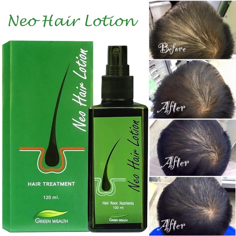 Neo Hair Lotion, Hair Growth Serum Essence Oil Hair Loss Treatment