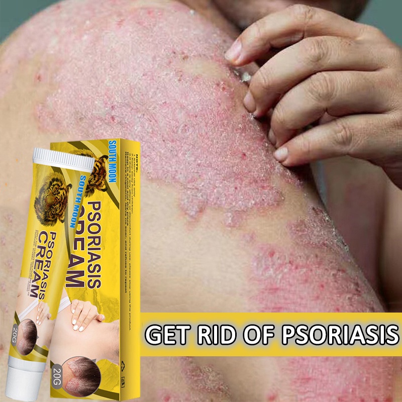 Psoriasis Cream Eczema Herbal Cream Herba Psoriasis Cream Antifungal