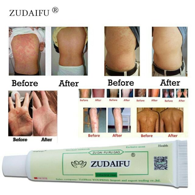 Krim Ajaib Ezcema/ Psoriasis/ Panau/ Gatal/ Kurap  Shopee 