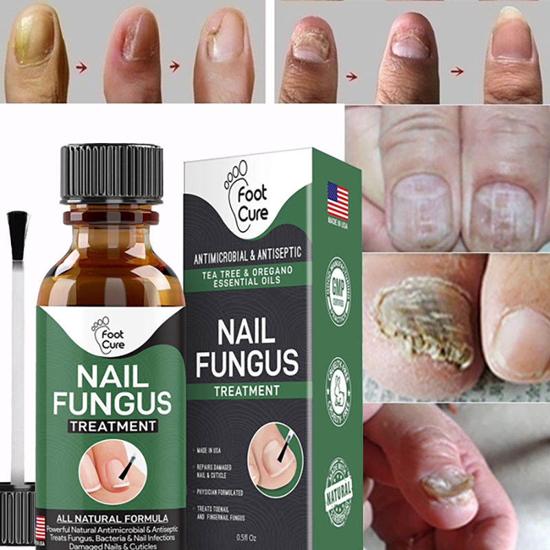 Extra Strong Nail Fungus Treatment Best Nail Repair Stop Fungal Growth Effective Fingernail Toenail Health Care Solution Fix Renew Damaged Broken Cracked Discolored Nails Shopee Malaysia