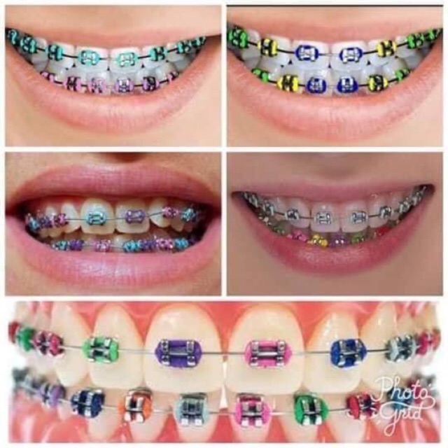 Lelong Murah Braces Click Atas Atau Bawah Sahaja Warna Mix Dapat Freegift Shopee Malaysia